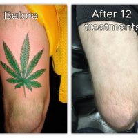 weed+leg+before+and+after+.jpg
